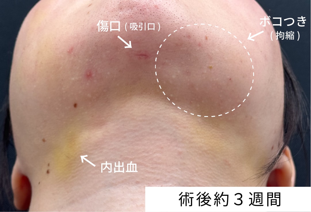 Q. 術後のボコつき（拘縮）は失敗ですか？いつ治りますか？
