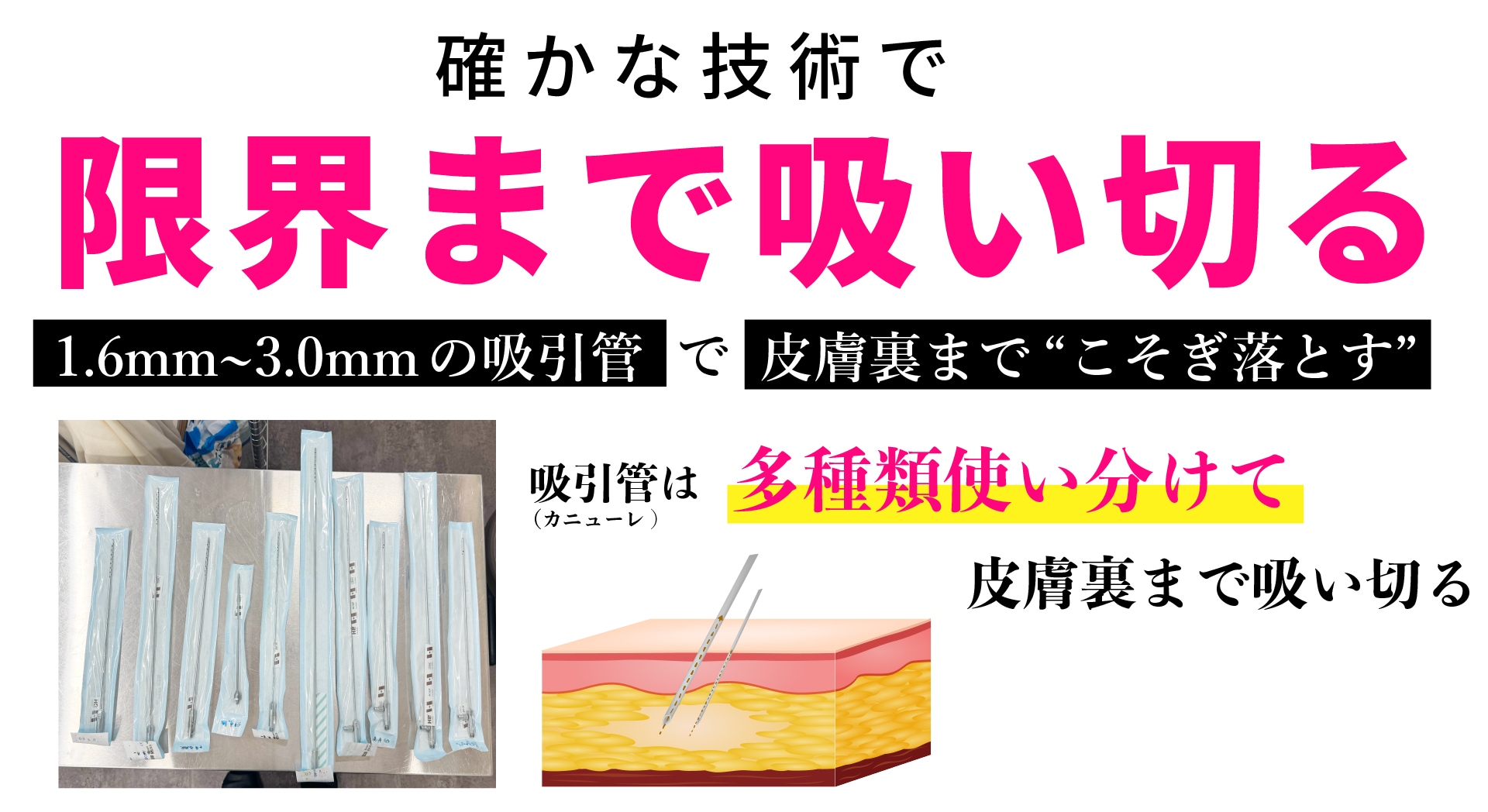 確かな技術で、極細の吸引管を自在に操り「ボコつきのない、自然な仕上がり」を作り出す