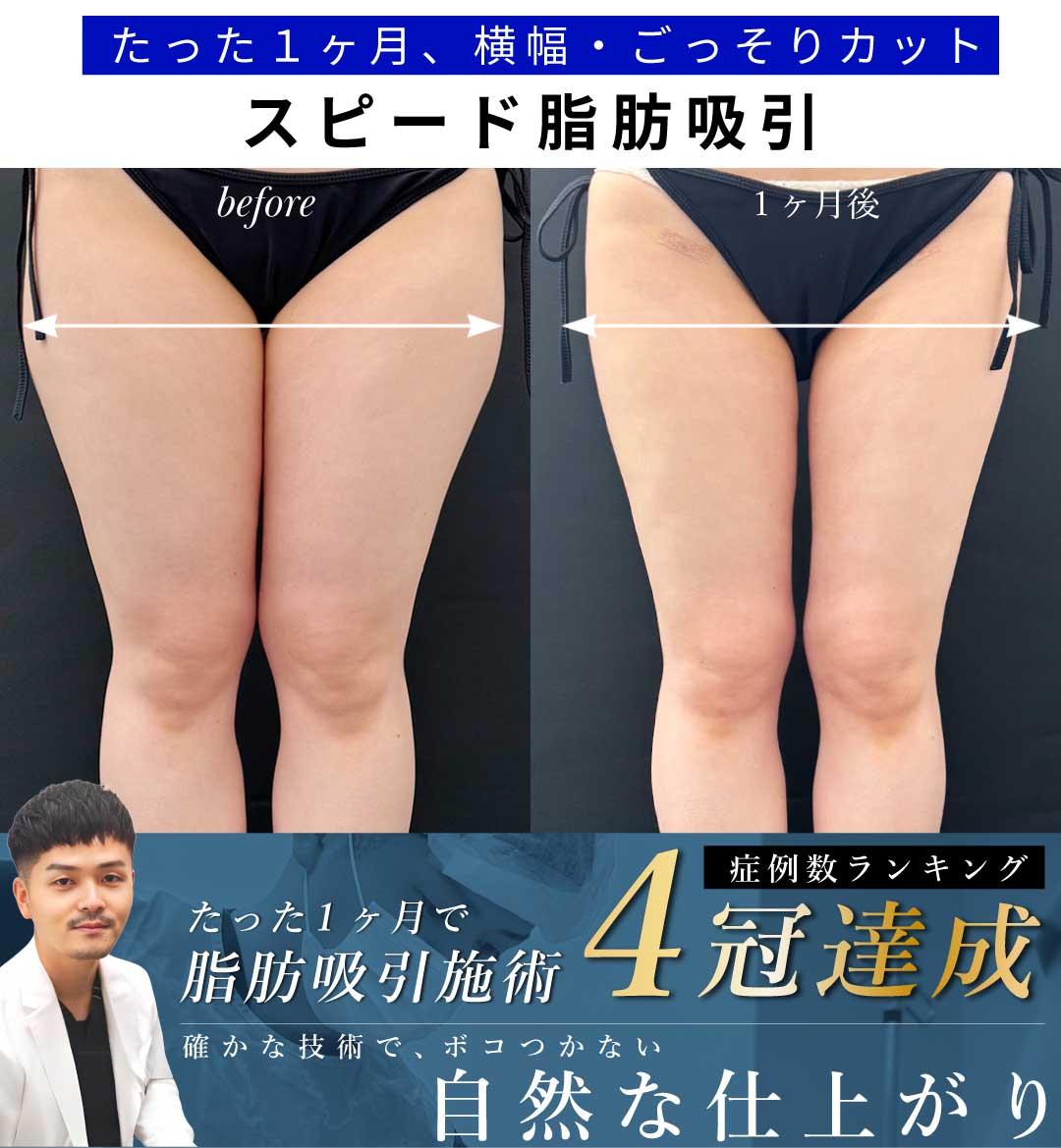 【大阪/脂肪吸引】ずっと悩んでた下半身の横幅を1ヶ月でごっそりカット!太もも&お尻のスピード脂肪吸引