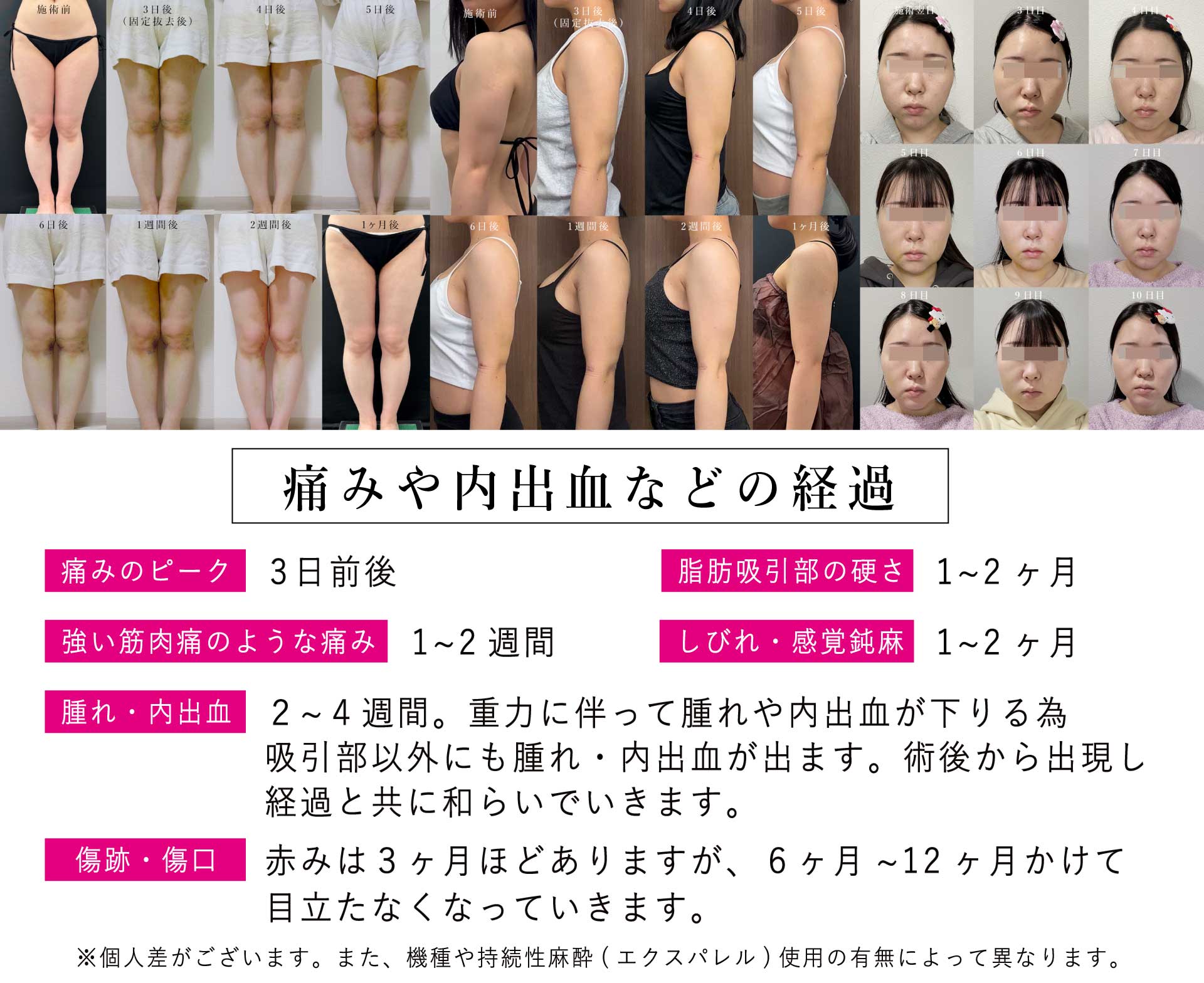 内出血や腫れ、痛みのピークと期間の目安