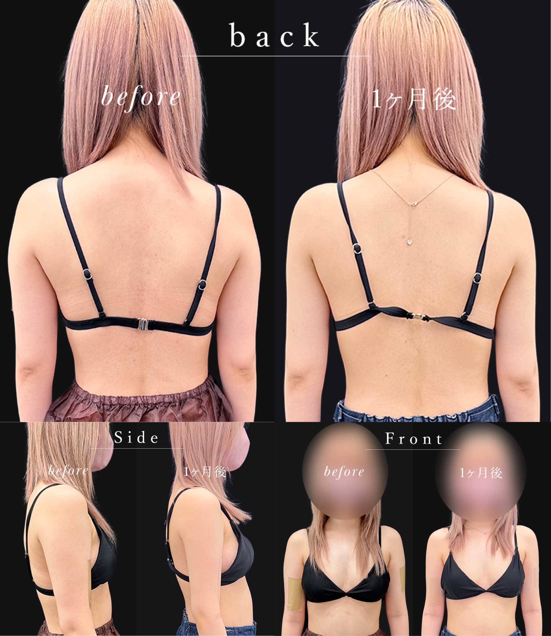 20代女性：アキーセル脂肪吸引 ベイザー併用(二の腕＋肩＋上背部) 上背部；肩甲骨横＋ブラ上＋ブラ下