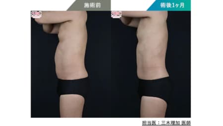 ＼ 腹部全体のボリュームが減り、ウエストラインがスマートに ／