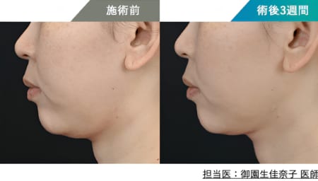 ＼ フェイスラインがスッキリ ／