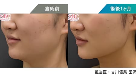 ＼ 全体の脂肪が減りほうれい線も薄くなりました ／