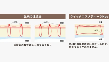 選ばれる理由2：まぶたの表面に傷がつかない！究極の「バレにくさ」