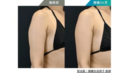 ＼ スッキリとした二の腕へ ／