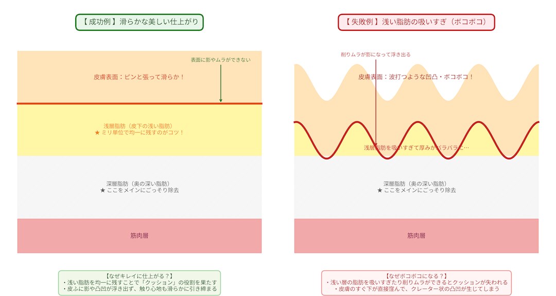 ① 浅い層の脂肪（浅層脂肪）を吸いすぎて皮膚が凹凸・ボコボコになる