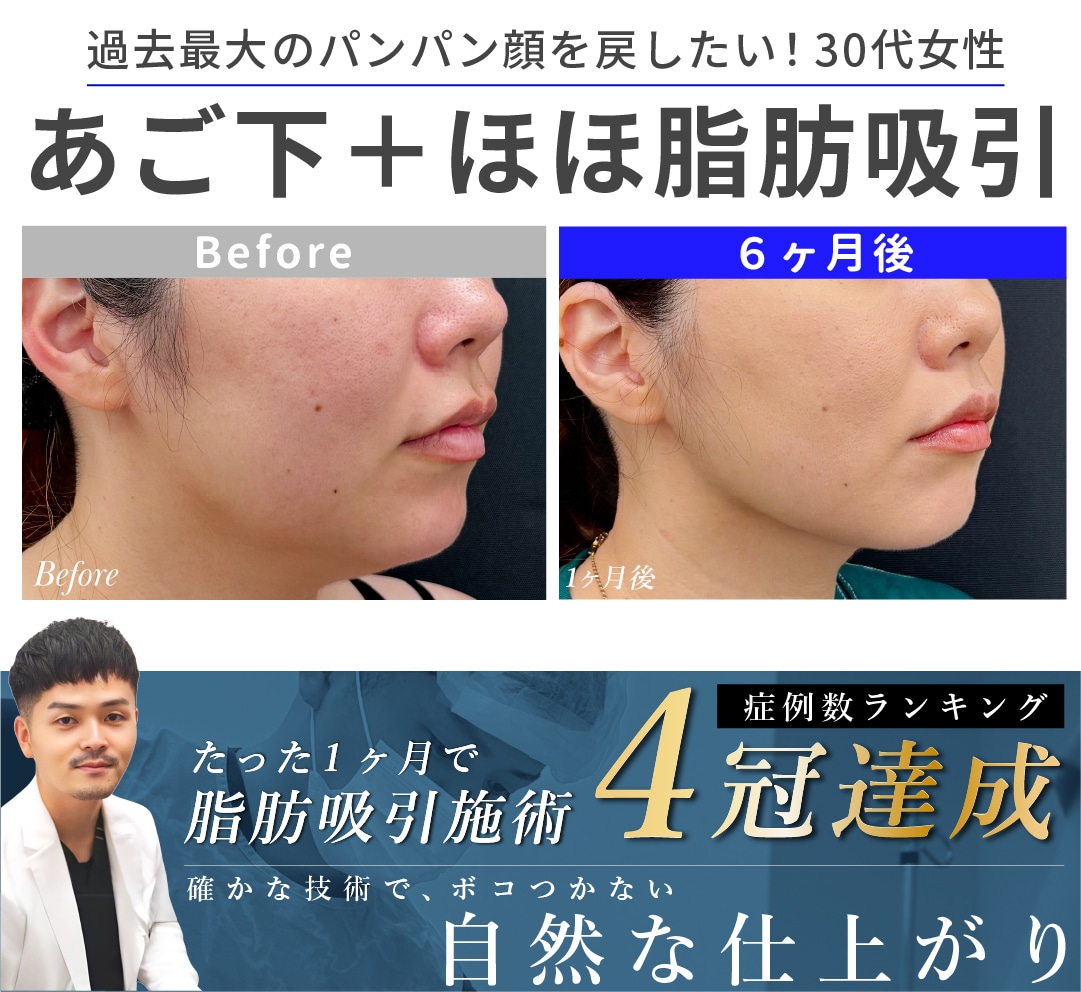 【大阪・なんば/脂肪吸引】レーザー治療から脂肪吸引に切り変え、短期で結果を出したい30代女性のお悩みを「症例数４冠」大阪堺東院 向山直樹医師が解決します！