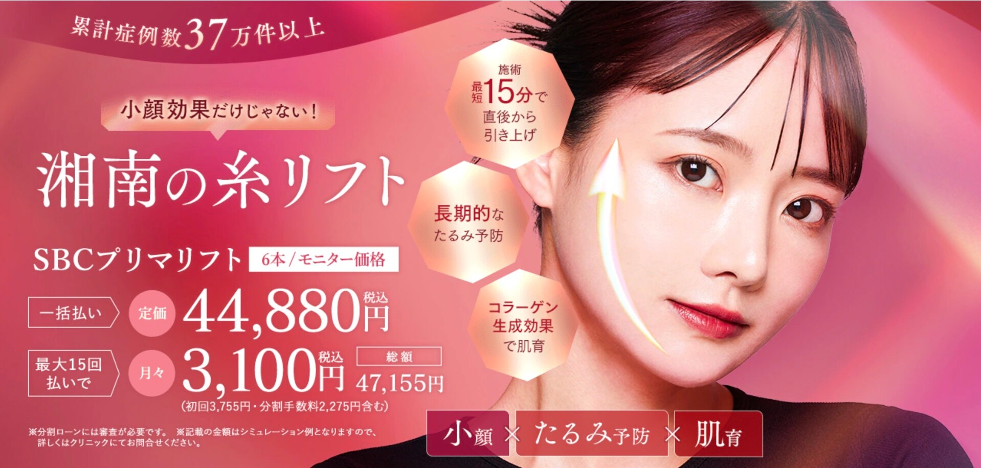 ③ 糸リフト：引き上げる力はあるが、上に乗る脂肪が重いとすぐ元に戻る<br />
