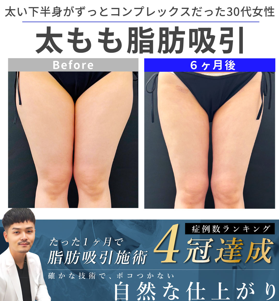 【大阪・なんば/脂肪吸引】ずっと下半身がコンプレックスだった30代女性のお悩みを「症例数4冠」大阪堺東院 向山直樹医師が解決します!
