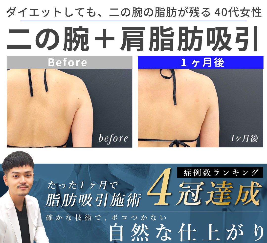 【大阪・なんば/脂肪吸引】ダイエットしても痩せなかった二の腕をなんとかしたい!40代女性のお悩みを「症例数4冠」大阪堺東院 向山直樹医師が解決します!