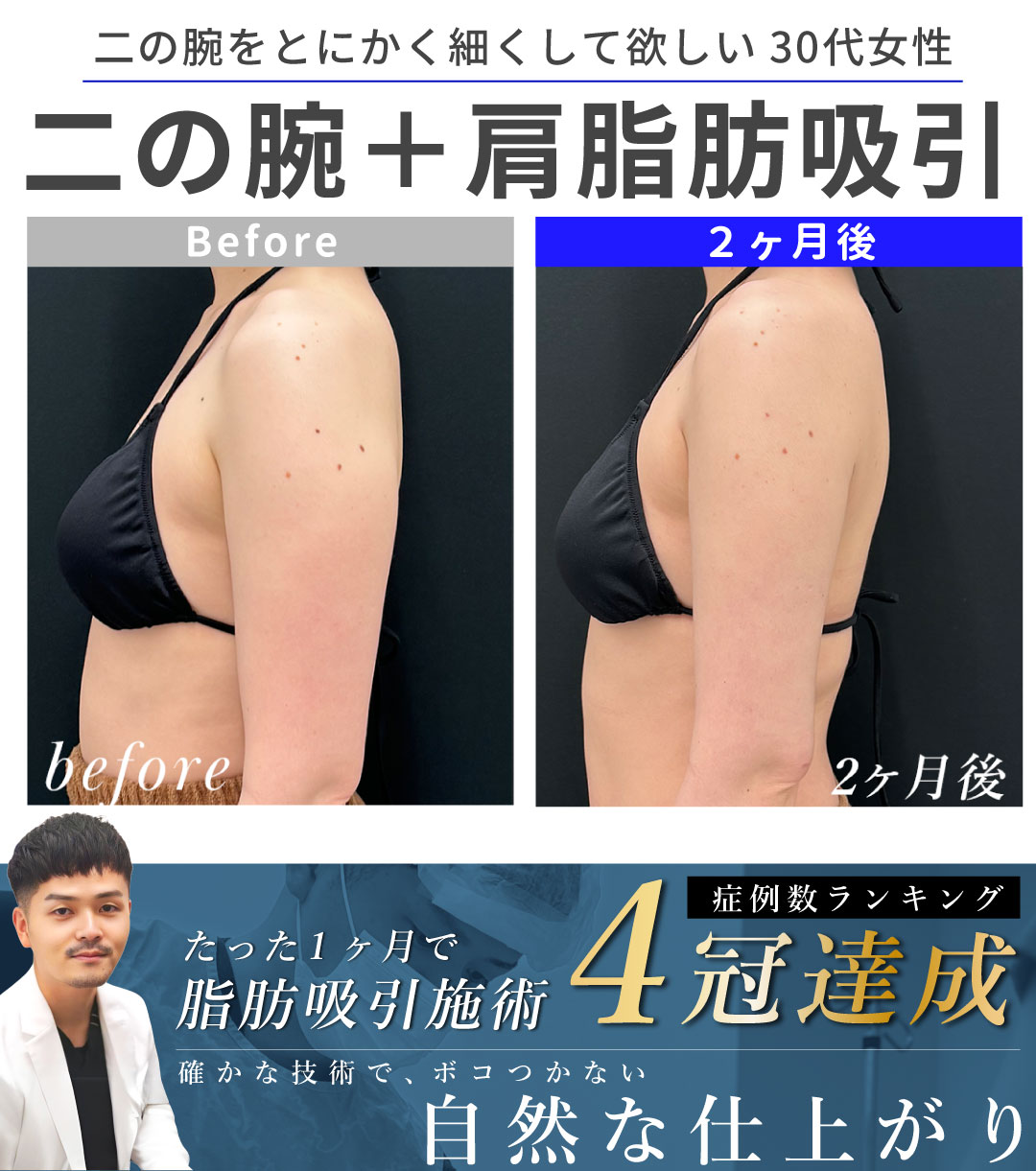 【大阪・なんば/脂肪吸引】とにかく腕を細くしたい!30代女性のお悩みを「症例数4冠」大阪堺東院 向山直樹医師が解決します!