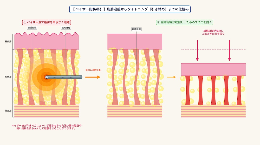 ベイザー（超音波）：固い脂肪を溶かしてごっそり吸引＆強力な皮膚引き締め