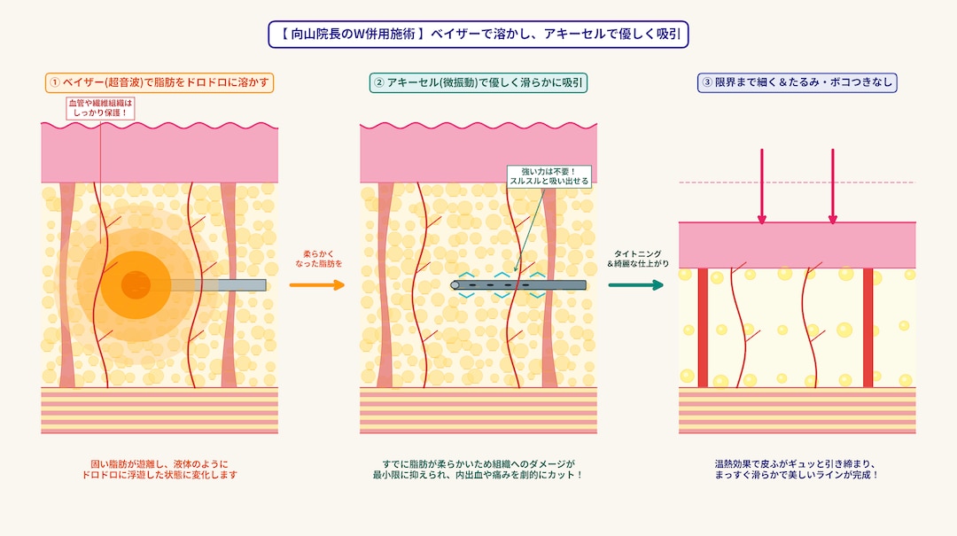 ① ベイザーで脂肪をドロドロに浮遊させ、アキーセルで優しく滑らかに吸引