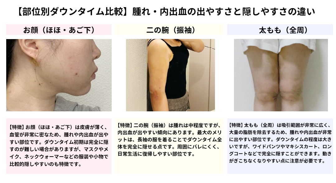 ② ダウンタイム（腫れ・内出血）の出やすさと隠しやすさの違い