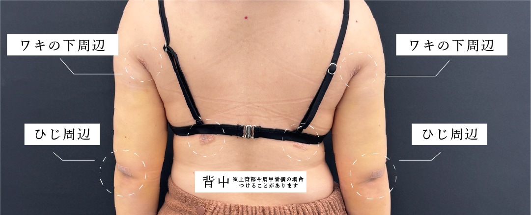 2. 傷口が目立たない「肘・脇のシワ」からのアプローチ