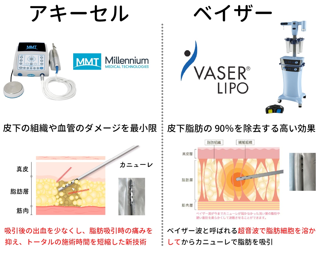 3. たるみ・ボコつきを防ぐ「アキーセル×ベイザー」を使用した技術力