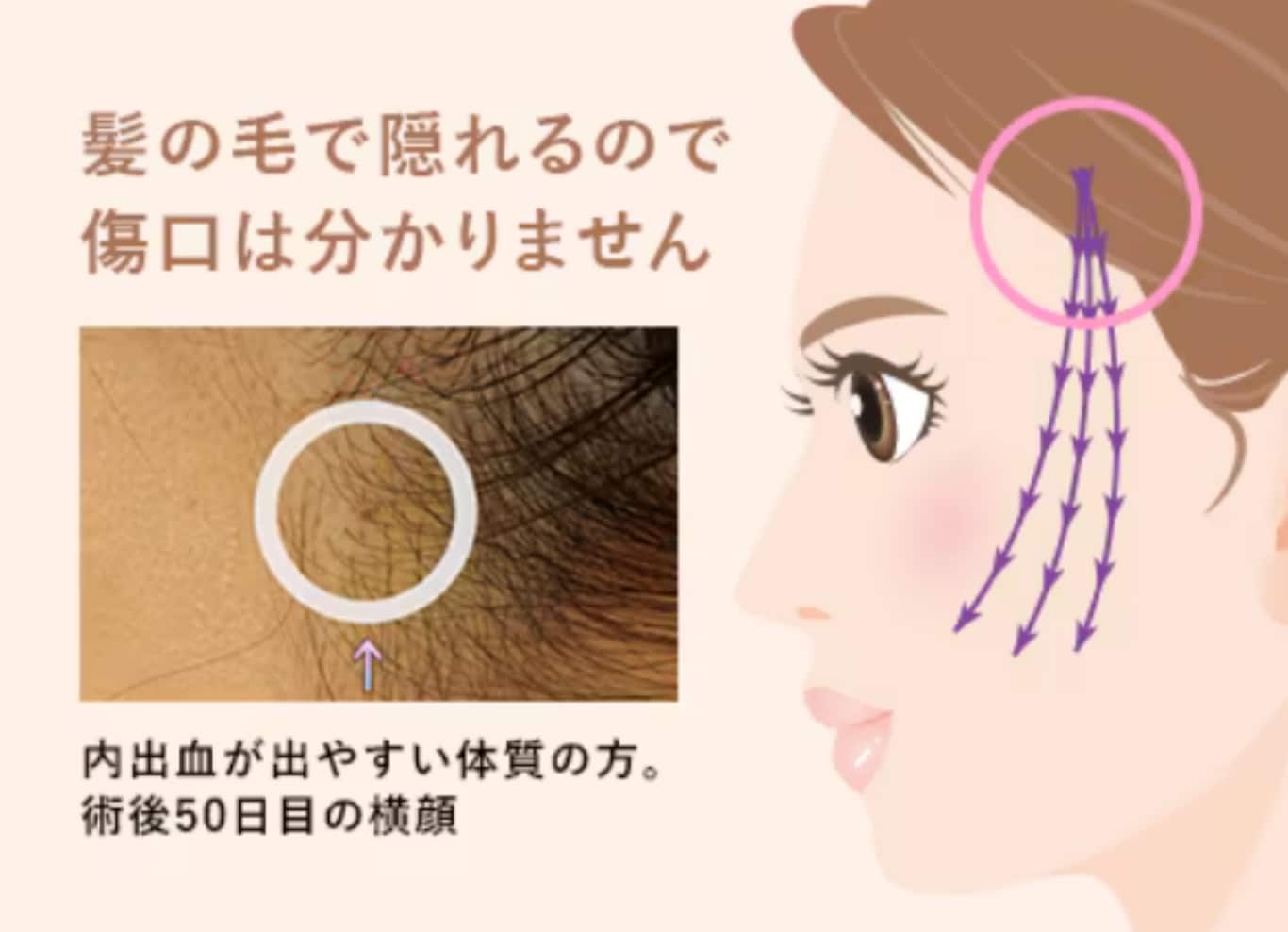 ダウンタイムを最小限に抑える技術
