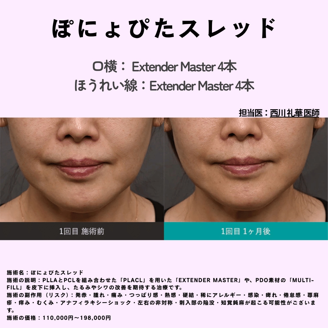 ぽにょぴたスレッド症例写真1