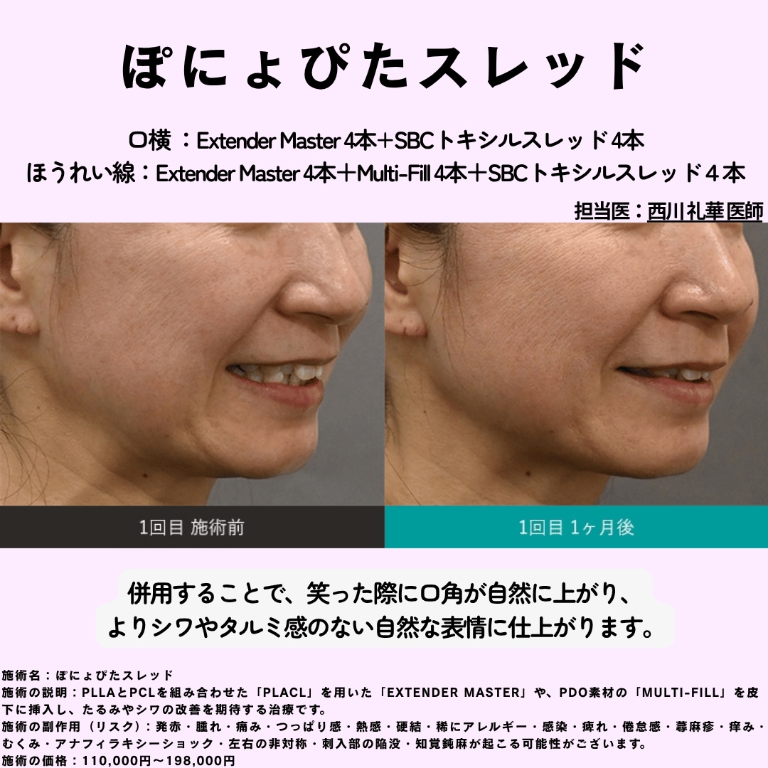 ぽにょぴたスレッド症例写真2