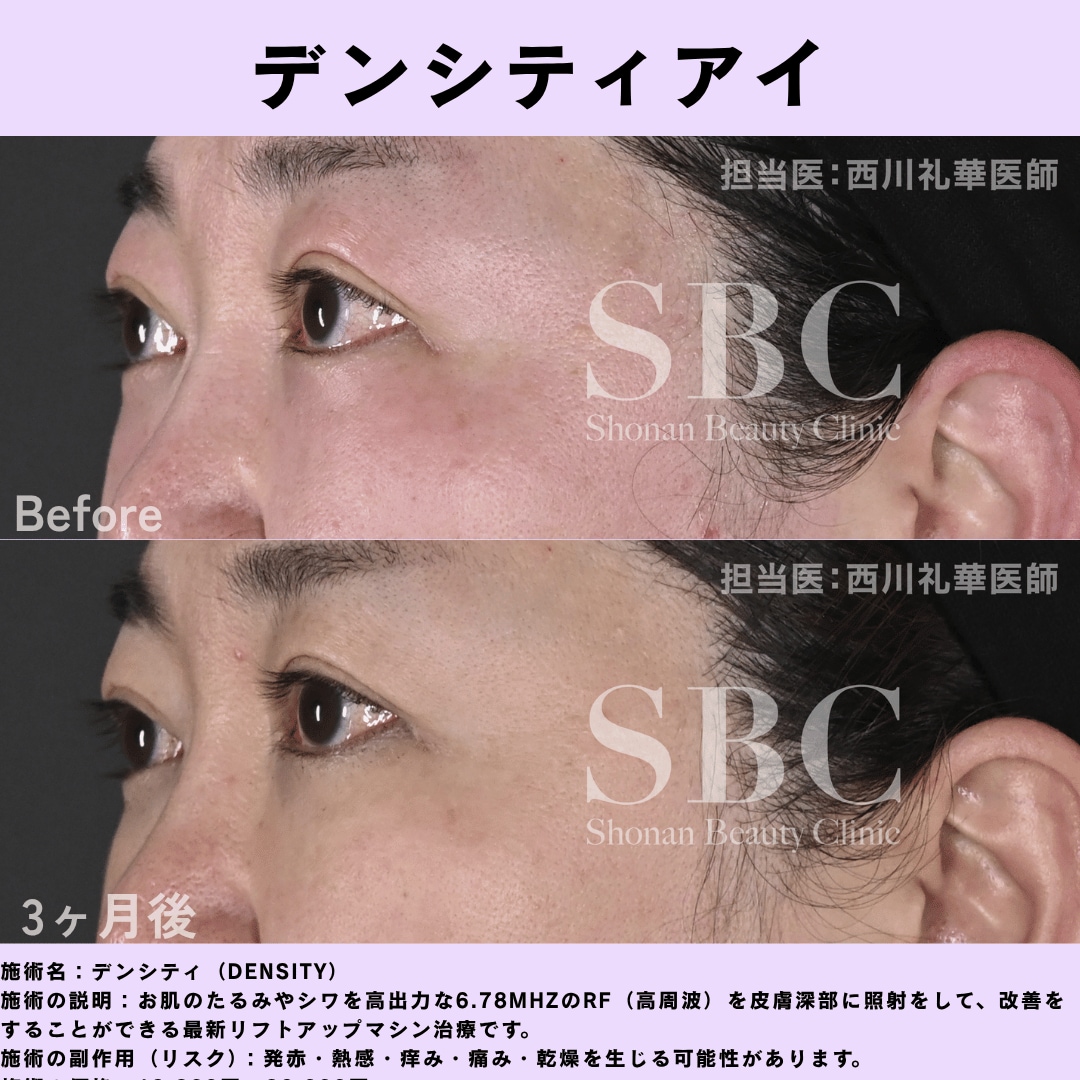 デンシティアイ症例写真