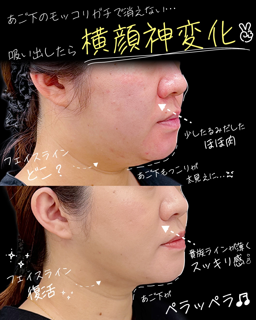 30代女性：ベイザー脂肪吸引(ほほ＋あご下＋ジョール)+VOVリフト６本　術後1ヶ月