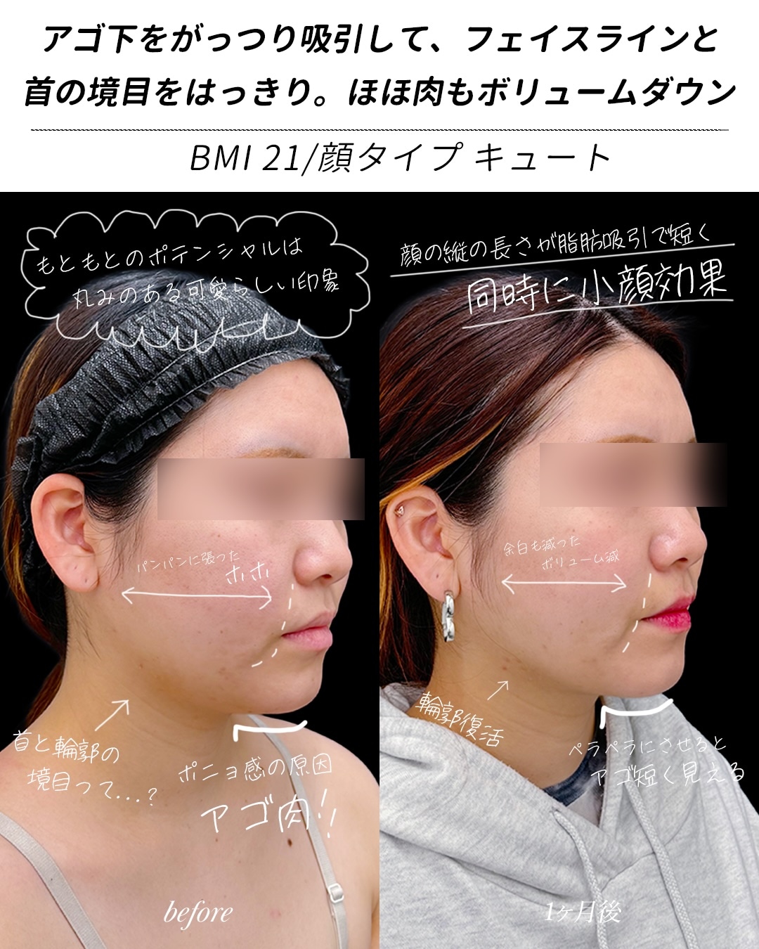 20代女性：ベイザー脂肪吸引(ほほ＋あご下＋ジョール)+シークレットリフト６本