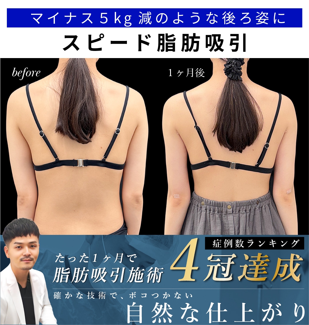 【大阪】1ヶ月で上半身を華奢にするスピード脂肪吸引が叶う理由と症例解説【向山院長】