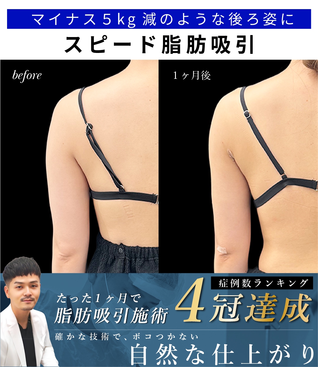 【大阪】脂肪吸引なのに1ヶ月でマイナス５キロに見えるの理由と症例解説【向山院長】