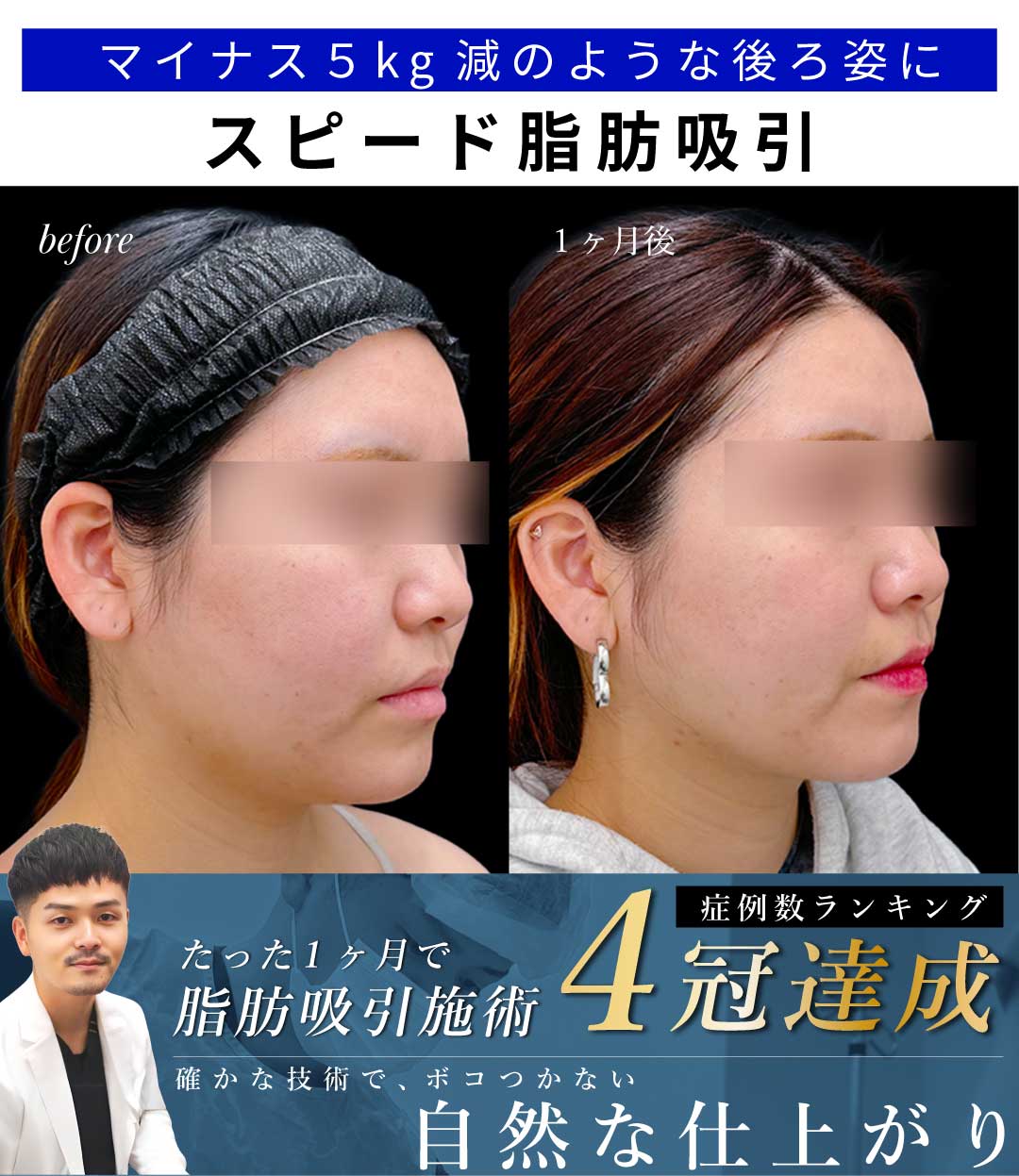【大阪】顔の脂肪吸引1ヶ月で劇的小顔!スピード完成の理由と症例解説【向山院長】