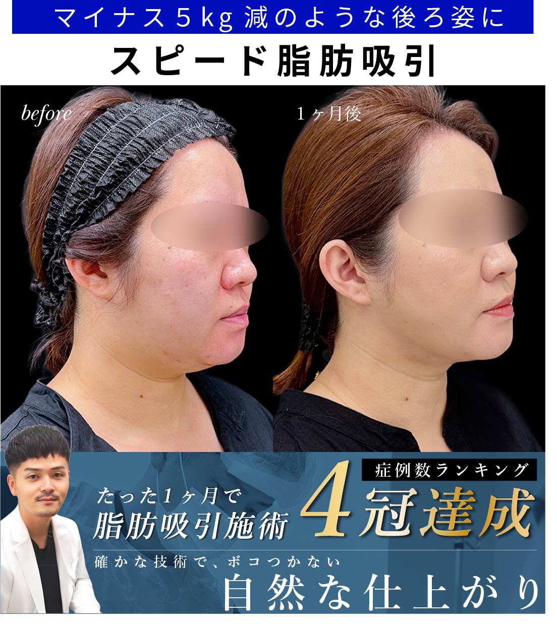 【大阪】顔の脂肪吸引1ヶ月で輪郭がスッキリ!スピード完成の理由と症例解説【向山院長】