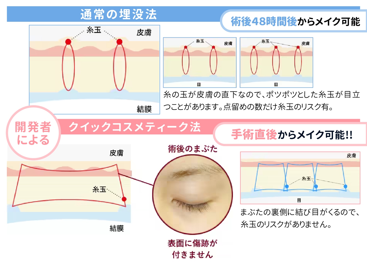 瞼板法?挙筋法?二重埋没法で腫れにくい・取れにくいのはどっち??2つの特徴を徹底解説! - 大阪梅田本院