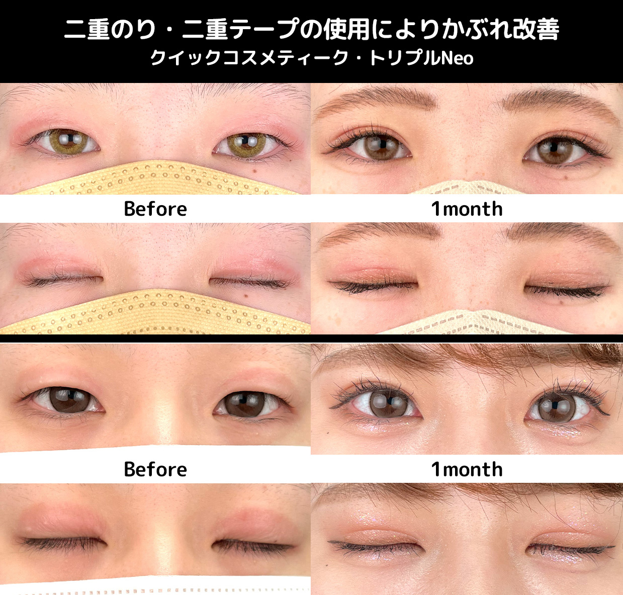二重のり・二重テープによるまぶたの炎症を改善