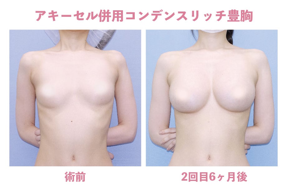 《脂肪注入豊胸》アキーセル併用コンデンスリッチ豊胸の症例
