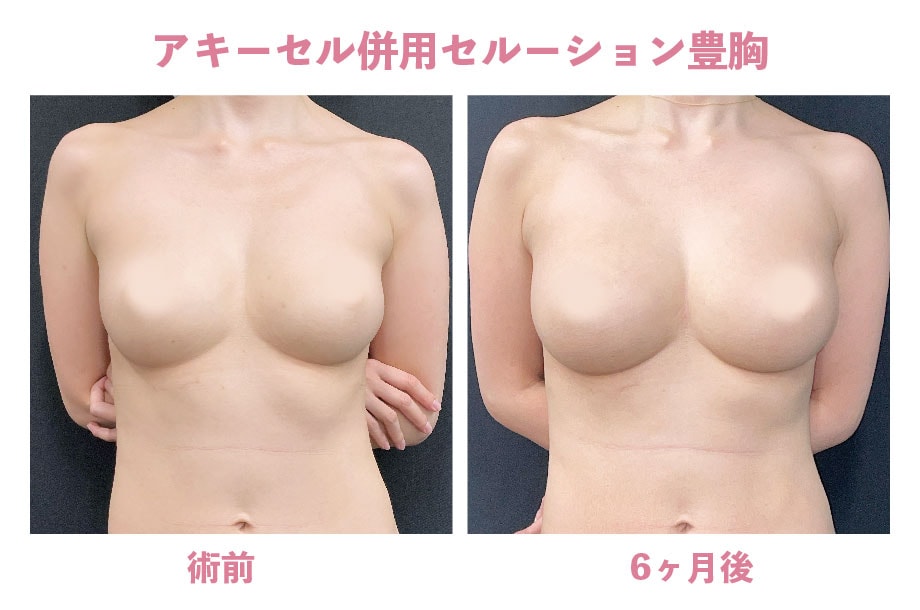 《脂肪注入豊胸》アキーセル併用セルーション豊胸の症例