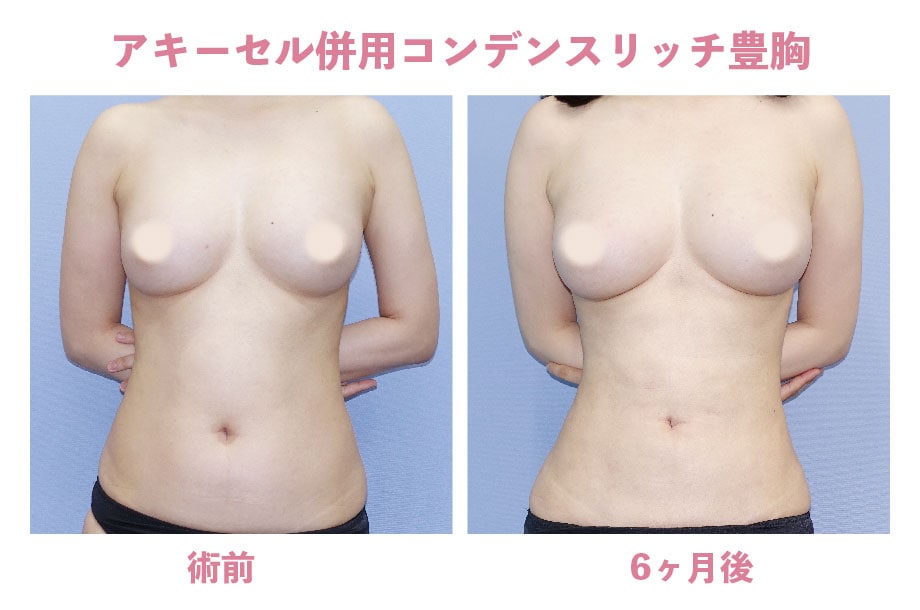《脂肪注入豊胸》お腹の脂肪吸引×コンデンスリッチ豊胸の症例