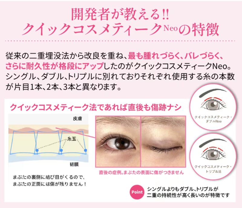 1番人気の埋没法・クイックコスメティーク法とは?
