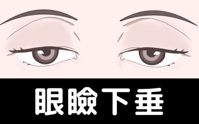 眼瞼下垂の症状が悪化する可能性