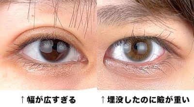 希望通りの二重幅やラインにならない