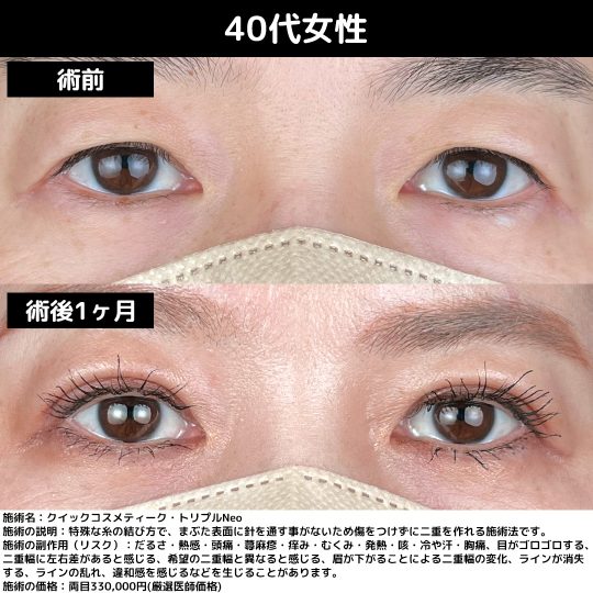 大阪で二重埋没するならSBC大阪梅田院の横谷医師