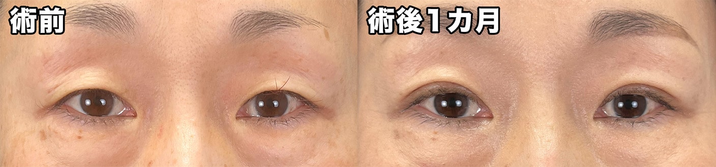 整形やった感ゼロの埋没法