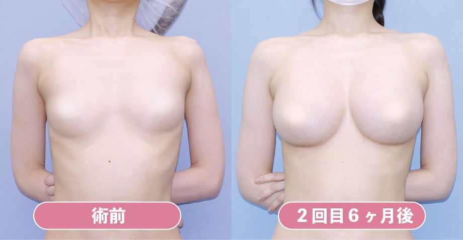 《脂肪豊胸》２次豊胸の症例