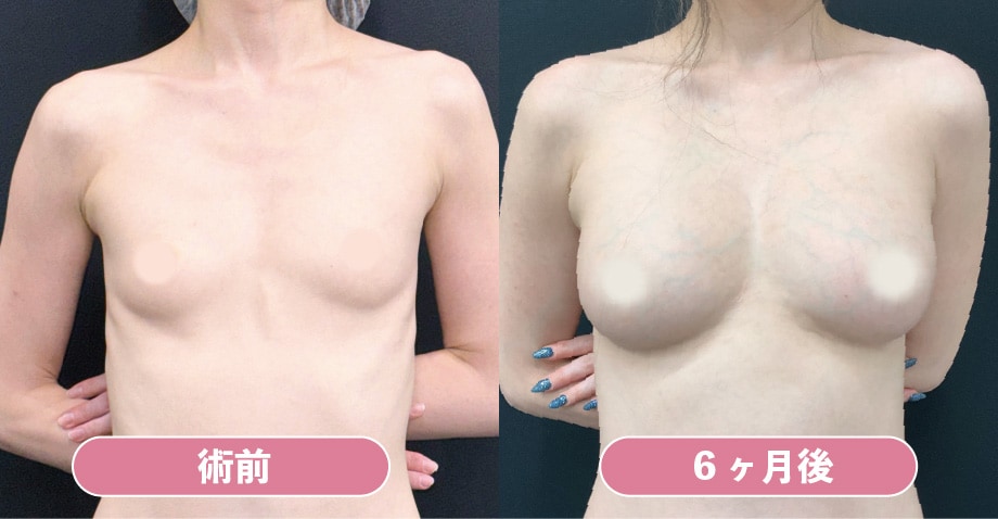 《脂肪豊胸》アキーセル併用コンデンスリッチ豊胸
