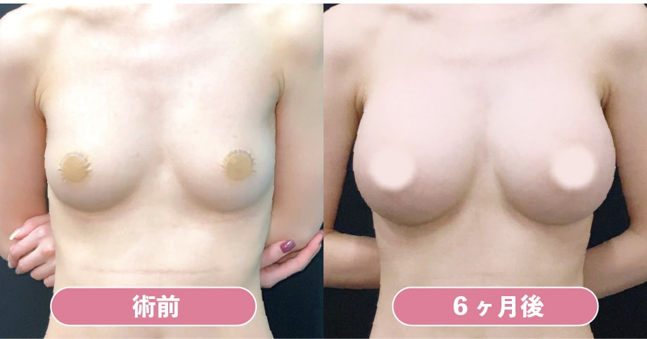 《シリコンバッグ豊胸》MESMO(両側300cc)の症例