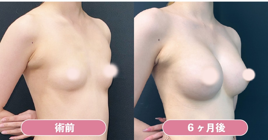 《ハイブリッド豊胸》MESMO(両側335cc)×コンデンスリッチ豊胸の症例