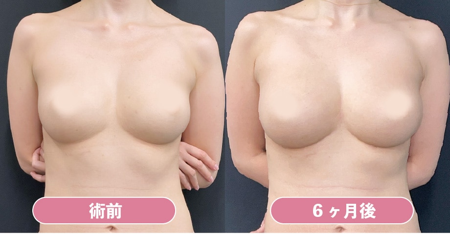 《脂肪注入豊胸》アキーセル併用セルーション豊胸の症例