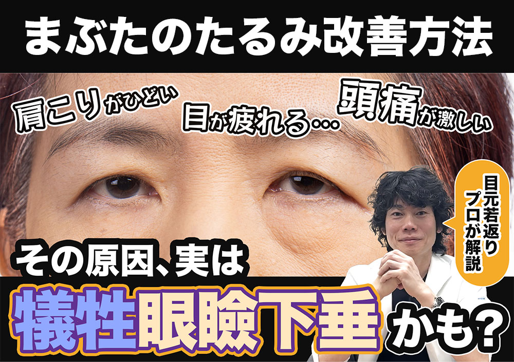 【まぶたのたるみ改善】これって眼瞼下垂？目の疲れ・肩こり・頭痛解消の原因と対処法を究明！