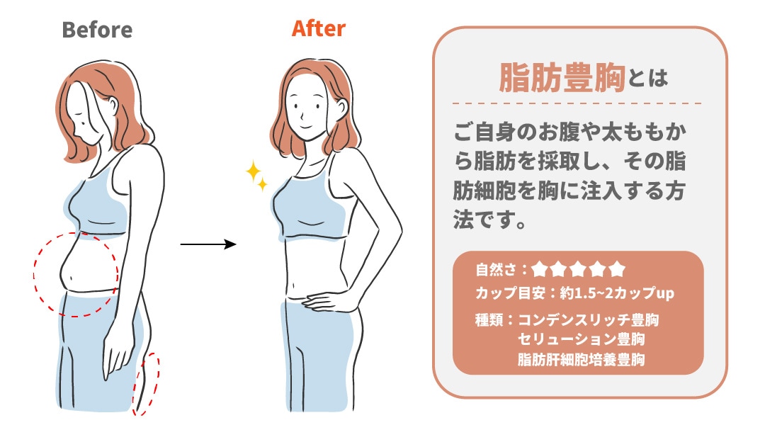 ご自身の脂肪を胸に注入する方法
