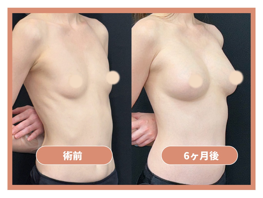 脂肪豊胸の症例①