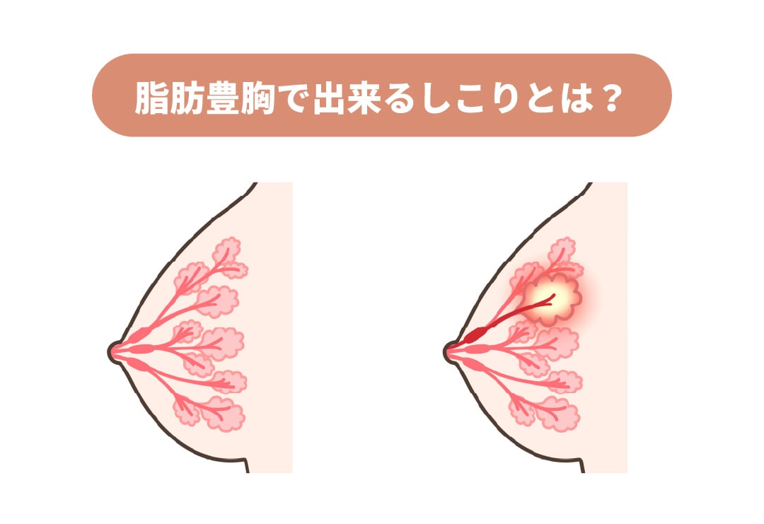 吸収されなかった脂肪細胞